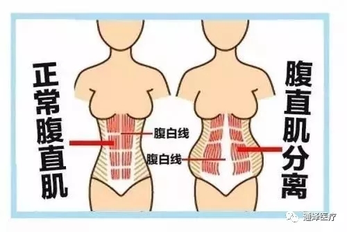 你知道腹直肌分離是什么嗎？