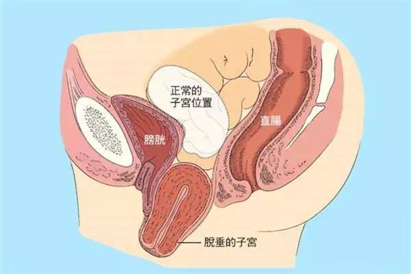【產(chǎn)后修復】盆腔臟器脫垂，你有嗎？