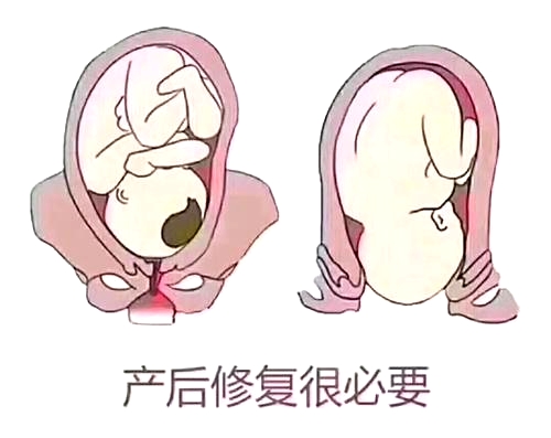 產(chǎn)后恢復項目好不好，兩大指標尤為關(guān)鍵