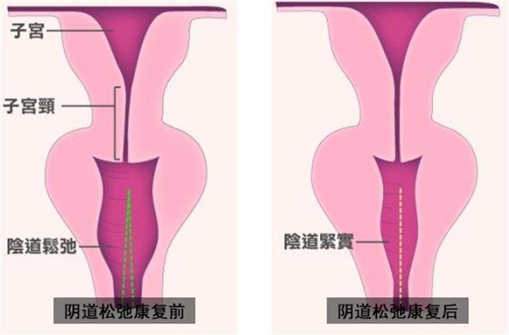 【盆底肌修復(fù)】盆底不修復(fù)，老來后患無窮