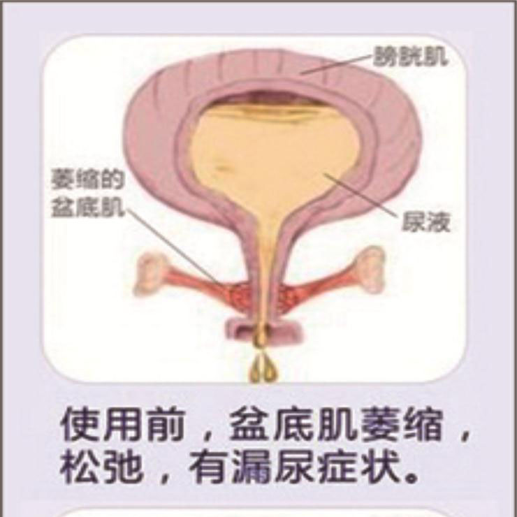 產(chǎn)后盆底肌康復|“社交癌”盯上你了嗎？