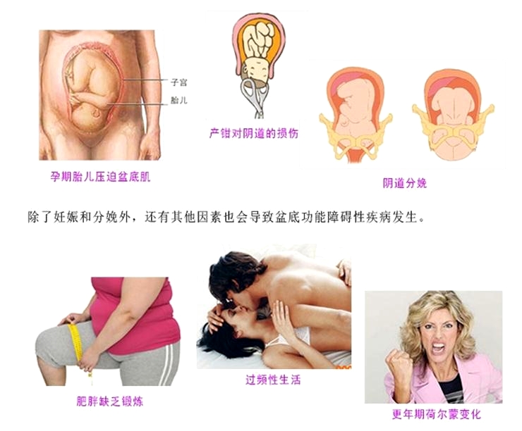 產(chǎn)后康復治療很重要，慢性盆腔痛很重要