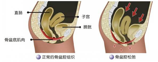 盆底功能檢測很重要，盆底肌松弛了會有什么表現(xiàn)呢？
